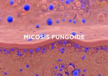 micosis fungoide