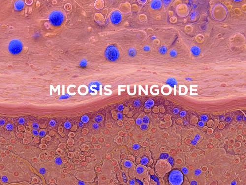 micosis fungoide